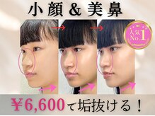 ラプリ 銀座店(Raplit)/隆鼻＋輪郭矯正40分30回