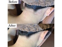 ビマナ 小岩店(NU美Mana)/【うなじ脱毛】