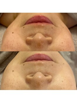 エミュ(e'mu)/効果実感!若見え施術