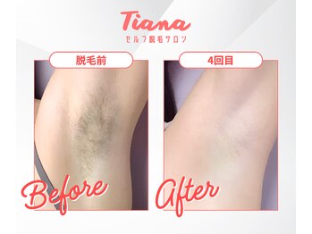 ティアナ(Tiana)/ワキ脱毛　Before&After