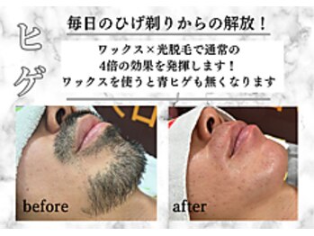 アルゴ 熊本八代店(ALGO)/【ヒゲ脱毛】毎日の髭剃り卒業