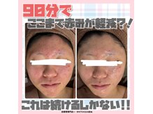 ホワイトアクア 岐阜店(WHITE AQUA)/ハーブピーリング/岐阜/ニキビ