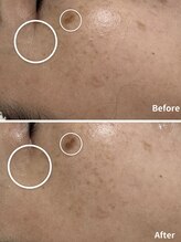 ベルエクラ(Bel Eclat)/シミ1回の施術　那覇/おもろまち