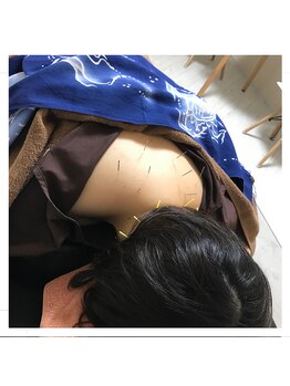 リー(Re)/施術例【首肩こり鍼施術】