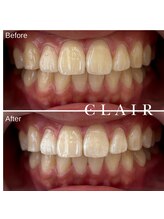 クレア(Clair)/セルフホワイトニング ¥1,100