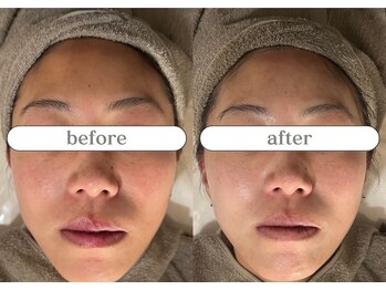 リスタ(RSTA)/【BEFORE/AFTER】