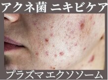 マヴィ くずは店(MavY.)/ニキビケア