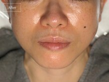 キュレイテッドスキン(CURATED SKIN)/ピーリング/毛穴ケア/肌質改善