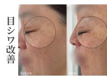 エトレ(etre)/ラミネーションピーリング/毛穴