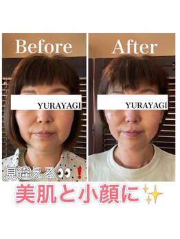 小顔屋ゆらやぎの写真/たるみ顔卒業！！疲れ顔→若見えフェイスに！