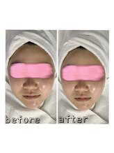 エクスクラメーションマーク(!!!)/超音波リフトアップ