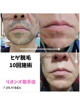 リオンズ 茨城ミスターマックス取手店/脱毛して良かった【脱毛】