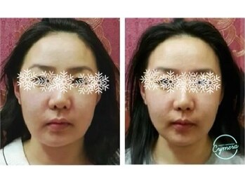 ケイビューティーサロン(K BeautySalon)/小顔リガメント(顔靱帯)コルギ