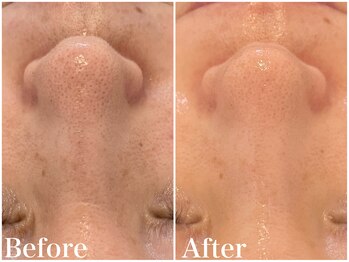 サロンドフェイス(Salon de Faith)/ハーブピーリング