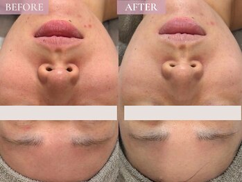 ベベ 表参道(bebe)/お悩み：赤み