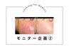 【モニター募集】肌診断+肌管理フェイシャル｜赤み・乾燥・毛穴開き・ニキビ