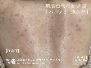 ラ ナチュラ(La natura)/HAABREPRO(ハーブピーリング)