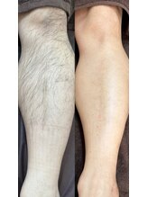 ビーンズ(BEANS)/脚脱毛