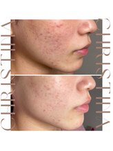 ティセラ(TISERA.)/『たった2回で』ニキビケア/赤み