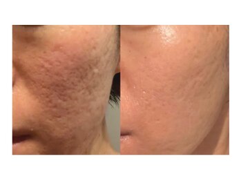 アールスタイルビューティ(R STYLE BEAUTY)/プラズマハ-ブピ-リング赤ニキビ