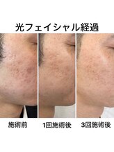 猫の手/肌荒れ改善☆光フェイシャル