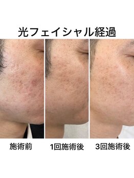 猫の手/肌荒れ改善☆光フェイシャル