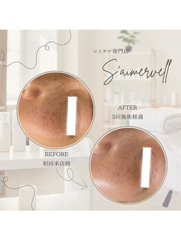 セメヴェール(Saimervell)/昔からの悩みもしみケアで改善!