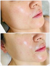 ココピュアレ(coco purele)/REVIハーブピーリング☆