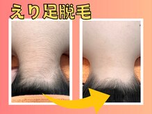 柏ベルミーランド/ヘアスタイルがキマる襟足脱毛！