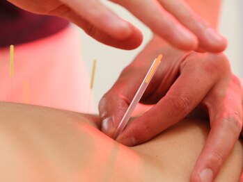 むさし鍼灸整骨院 大宮院/頑固な症状は鍼で直接緩めます！