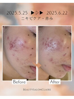 クレール(Claire)/【イラストリアス】ニキビケア