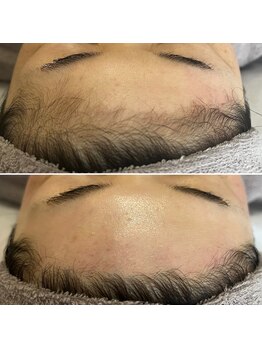 トリプルワン(111)/人気のフェイシャルワックス脱毛