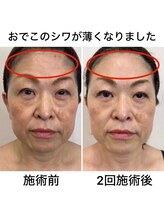 猫の手/シワにもアプローチ☆光フォト