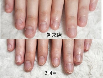 グラシナ なんば店/深爪/自爪育成/フィルイン