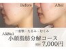 【二重顎・たるみ悩みNo.1☆】脂肪分解で横顔スッキリ小顔☆初回7,000円