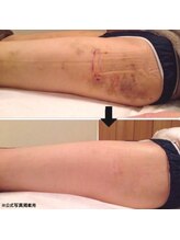 レア(Le'a)/術後ケアにインディバ♪