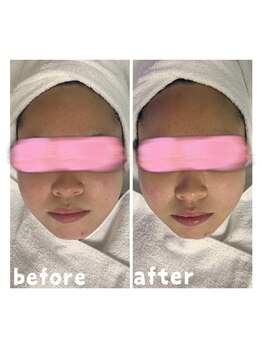 エクスクラメーションマーク(!!!)/超音波リフトアップ