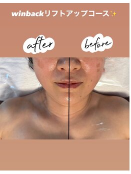 クレーアインス(kleeins)/WINBACK リフトアップコース☆