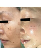 ホワイトアクア 天王寺本店(WHITE AQUA)/ララピール/大阪/天王寺/毛穴