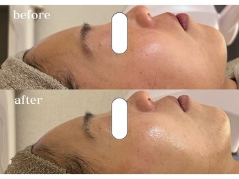 リスタ(RSTA)/【BEFORE/AFTER】