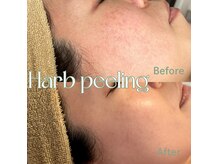 ティセ(TisseR)の雰囲気（ハーブピーリングでノーファンデ！毛穴レスツヤ感ある美肌へ！）