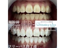 ホワイトニングサロン 福岡天神店/ホワイトニング
