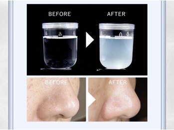 エステサロン アンジュール(Angelle)/ハイドロピーリング