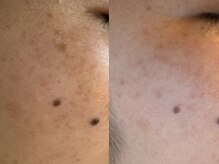 サラグランデ(Sara Grande)/しみケア３回