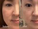 ハリスキンラボ(Hari.Skin.Lab)の写真/たるみが気になる方へ、ダウンタイムなしのリフトアップを。