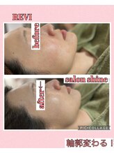 サロンシャイン(Salon Shine)/REVI４０代女性エラ周り小さく