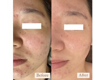 ミラ(Mila)/ニキビケア2ヶ月間の変化！