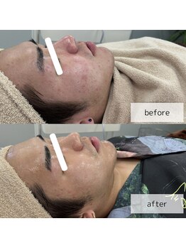 ヴィーナス(Venus)/韓国ダーマエステ　6回