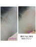 【レディース脱毛】えりあしうなじWAX＆マシン　　¥4400