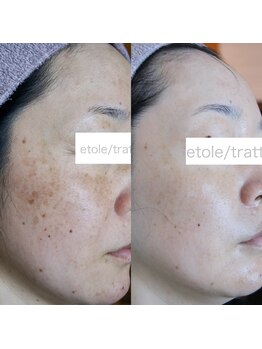 トラット エステアンドアイズ(tratto)/40代　お客様症例写真